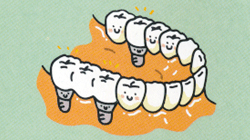 バネ付きの入れ歯ではなく、歯のない部分に適切な数のインプラントを入れ、固定式の人工歯を取り付けます。